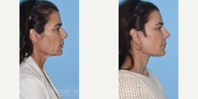 54 year old woman treated with Facelift - 54 year old woman treated with Facelift and Neck Lift