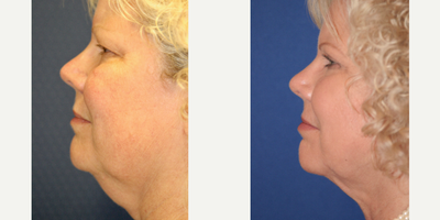55-64 year old woman treated with Liposuction - Neck Liposuction
