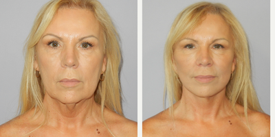 55-64 year old woman treated with Facelift, MACS Facelift - 60 year old lady requesting facial rejuvenation. Modified extended MACS facelift
