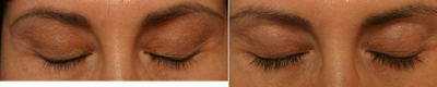 LATISSE - Patient had thin, sparse eyelashes. Dramatic growth shows with application of Latisse, thick, darker, and longer growth.