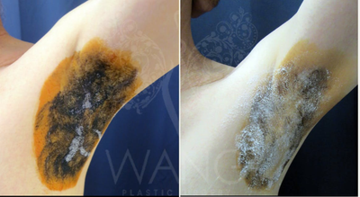64-year old Male Treated with MiraDry - This patient suffered from excessive sweating and odor and 3 months after treatment, patient saw 80% improvement. Our Miradry patients have reported an average of 70% improvement at one year and 60% to 70% improvement at 2 years with a single treatment. The results are even better with 2nd treatment. We believe that MiraDry has long lasting effect on sweat and odor reduction. We use the starch-iodine test as a guide to help us capture the most active areas of sweating. The iodine stains seen in both pre and post treatment photos shows the sweat glands most active in the underarms. After 1st treatment, the iodine stain shows significant decrease of active sweat glands. MiraDry is a non-invasive, non-surgical alternative which has proven to be quite effective in sweat/odor reduction. MiraDry has very minimal risk and complication profile and has shown to be quite effective in our practice for the past 2 year.