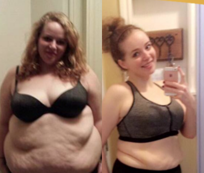 25-34 year old woman treated with Sleeve Gastrectomy - Gastric Sleeve Surgery performed by Dr. Jorge Maytorena in Tijuana Mexico