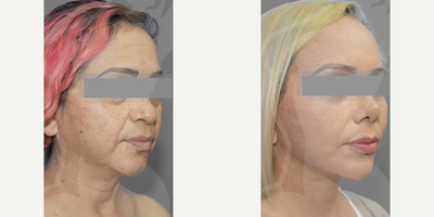 Woman treated with Rhinoplasty, Eyelid Surgery - Your age is your business. How young you look is mine.We renewed and came back with this stunning case. Our patient was rejuvenated and definitely in love with her results. Procedures: Ritidectomy + Blepharoplasty + Rhinoplasty