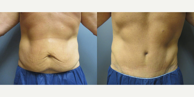 45-54 year old man treated with Panniculectomy - 49 year old male 5 months after panniculectomy with liposution