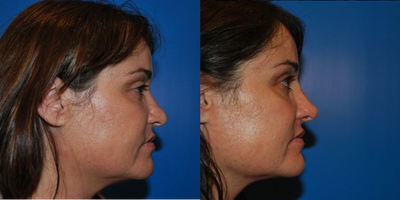 Revision Rhinoplasty - 
	Revision Rhinoplasty

