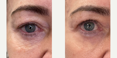65-74 year old woman treated with Halo Laser, ProFractional Laser - HALO and ProFractional laser treatments performed at 8 West Clinic, Vancouver, BC