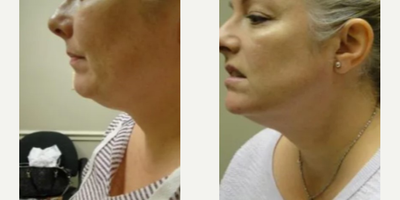 Woman treated with Infini RF - Woman treated with Infini RF
