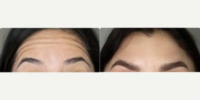 25-34 year old woman treated with Botox - When we do a botox application, we do it with a proprietary technique that allows us to give natural results without altering the facial expression. This technique is called multipoint microdosing and it involves applying small doses in multiple points and what is really important here is the form of application.