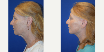 65-74 year old woman treated with Lower Face Lift - 65-74 year old woman treated with Lower Face Lift and a Lateral Brow Lift