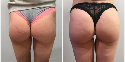 25-34 year old woman treated with Sculptra Aesthetic Butt Lift - Patient's hip dips were filled with dermal fillers.