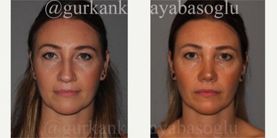 35-44 year old woman treated with Lip Repositioning, Rhinoplasty - 35-44 year old woman treated with Lip Repositioning
