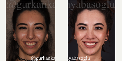 25-34 year old woman treated with Lip Repositioning - 25-34 year old woman treated with Lip Repositioning