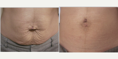 35-44 year old woman treated with Skintyte - Before/After 4 months post 10 treatments