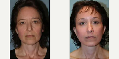 Woman treated with Facelift - Woman treated with Facelift.
