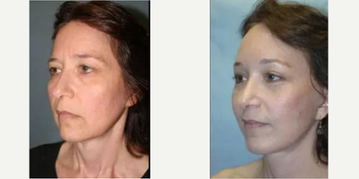 Woman treated with Facelift - Woman treated with Facelift.