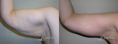 Arm Lift - Follow-Up: 1 Month