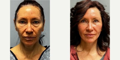 Woman treated with Neck Lift - Woman treated with Deep Plane Facelift, Deep Plane Neck Lift, Eyelid Surgery through upper and lower blepharoplasty, Brow Lift through Renuvion, Facial Fat Transfer through lipocube, and CO2 Laser Skin Resurfacing.