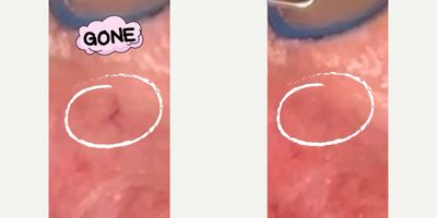 Woman treated with Laser Genesis - Woman treated with Laser Genesis