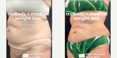 Woman treated with truSculpt, truFlex - Woman treated with truSculpt, truFlex