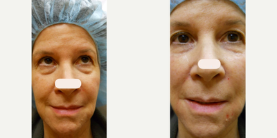Woman treated with Radiesse - Woman treated with Radiesse.