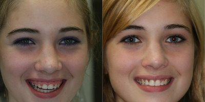 17 or under year old woman treated with Gum Lift - Mom brought this young lady in for a consultation because she wondered if her daughter felt embarrassed by her gummy smile because she would hardly ever smile, especially in pictures. This young lady if that was the case and she say no! She was not embarrassed by her smile. We ended up doing the laser gum lift in about 20 minutes.