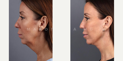 Woman treated with Deep Plane Facelift - Transformations that speak for themselves! Swipe through to see the incredible before and after results of a deep plane facelift performed by Dr. Marotta. Witness the power of expert craftsmanship and the beauty of facial rejuvenation.