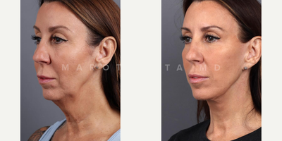Woman treated with Deep Plane Facelift - Transformations that speak for themselves! Swipe through to see the incredible before and after results of a deep plane facelift performed by Dr. Marotta. Witness the power of expert craftsmanship and the beauty of facial rejuvenation.