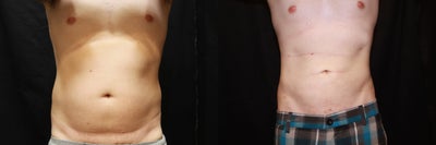 Laser Liposuction - Abdomen - 
	Laser Liposuction - Abdomen
