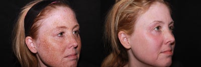 Laser Fractional Resurfacing - Laser Fractional Resurfacing