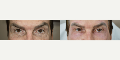 55-64 year old man treated with Laser Peel, Laser Resurfacing, CO2 Laser, Coolaser, Clear and Brilliant, Halo Laser, MiXto Laser - Many consumers think only women undergo cosmetic procedures. The reality is that all of us want to look our best and men are becoming a larger and larger part of the patient population. Especially in leadership and sales positions, patients tell us looking good is important for their career.  Sciton Moxi, Sciton Halo, Sciton Microlaserpeel.