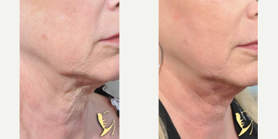 Woman treated with Profound RF - Woman treated with Profound RF