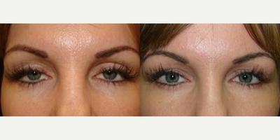 35-44 year old woman treated with Ptosis Surgery - Patient had ptosis repair for droopy eyelids, as well as blepharoplasty.