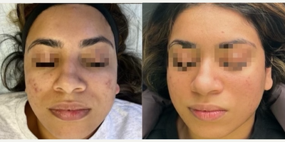 Woman treated with Microneedling RF, LaseMD - Woman treated with Microneedling RF, LaseMD