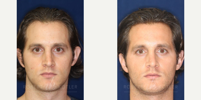 Permanent Non-surgical Rhinoplasty - Correction of unsightly pinched tip.