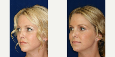 Permanent Non-surgical Revision Rhinoplasty - Correction of crooked nose. Concealment of tissue loss and visible cartilage graft. All resulting in a nose that no longer appears over operated.