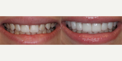 Woman treated with Tooth Repair - Woman treated with Tooth Repair using 10 minimal/no-prep veneers for smile enhancement. She previously had Invisalign but was still dissatisfied with the appearance of her teeth.