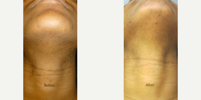 Patient treated with Laser Hair Removal - Patient treated with Laser Hair Removal