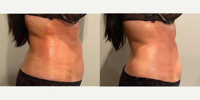 25-34 year old woman treated with Body Wrap - Before and immediately after one Bioslimming Body Wrap at Wise Med Spa