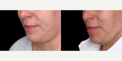 39 year old woman treated with Volbella - 39 year old woman treated with Volbella. Photos depict before and 1 month after 1 syringe of Volbella to lips.