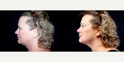 58 year old woman treated with Thread Lift - 58 year old woman treated with Thread Lift. Photos depict before and 3 months after 6 Instalift Sutures