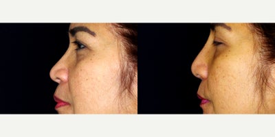 55-64 year old woman treated with Asian Rhinoplasty - 57 year old woman treated with Asian Rhinoplasty. Photos depict before and 3 months after surgery.