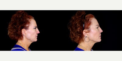 60 year old woman treated with Thread Lift - 60 year old woman treated with Thread Lift. Photos depict before and 3 months after 18 Novathreads