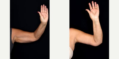 66 year old woman treated with Arm Lift - 66 year old woman treated with Arm Lift (brachioplasty) Photos depict before and 1 month after surgery.