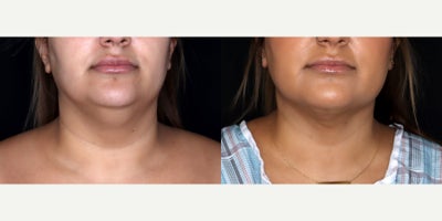 32 year old woman treated with PrecisionTx - 32 year old woman treated with PrecisionTx. Photos depict before and 6 weeks after surgery