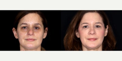 48 year old woman treated with Rhinoplasty, Septoplasty, Facial Fat Transfer - 48 year old woman treated with Rhinoplasty, Septoplasty, Facial Fat Transfer to undereyes. Photos depict before and 3 months after surgery