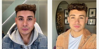NEW YEAR, NEW CONTOUR - Our patient today is back with us for another treatment, as he loved his previous results so much. He knows we are the best so he flies from out of state to see us. In the past, we have used filler for his lips- but today we are venturing to his jawline and chin as well. He already had great features, so we just enhanced them making his jawline more chiseled, chin more square, and adding a touch of volume to his lips to complete the look. Immediately after treatment he was slightly swollen but that diminished after a couple of days. He is so glad he made the decision to get facial sculpting, as he is loving his results.