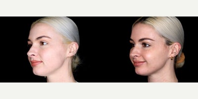 27 year old woman treated with Thread Lift - 27 year old woman treated with Thread Lift. Photos depict before and 1 month after 10 novathreads.