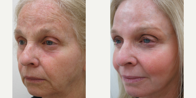 55-64 year old woman treated with Chemical Peel - Patient treated with a customized Chemical Peel.