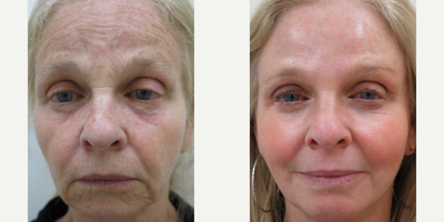 55-64 year old woman treated with Chemical Peel - Patient treated with a customized Chemical Peel.