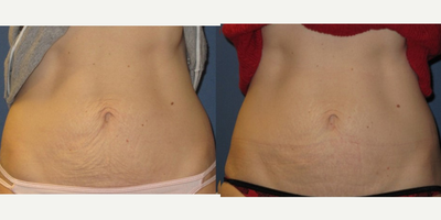 skin tightening - skin tightening